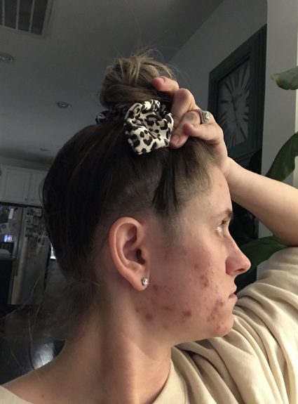 MY SKINCARE JOURNEY CLEARING CYSTIC ACNE.